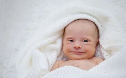 Figure 8: Down syndrome