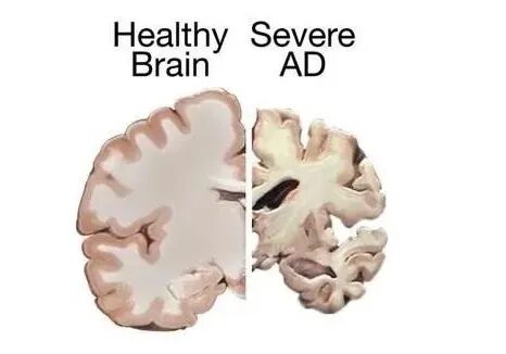 Figure 3: A comparison showing brain atrophy in Alzheimer's disease
