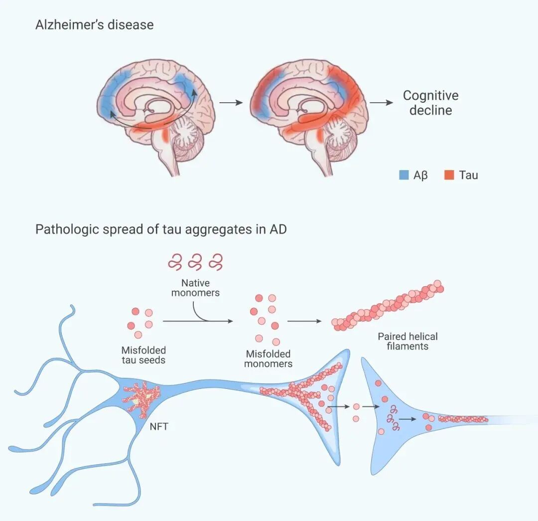 Figure 4: One feature associated with Alzheimer's disease—abnormal protein accumulation